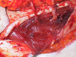 Perforator blood vessels and nerve coming from Deep Inferior Epigastric blood vessels and nerve