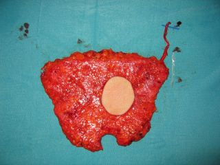 Breast reconstruction with skin-island DIEP flap in skin sparing mastectomy, an intraoperative view of the flap rotated 180° to show positioning at the recipient area. Note vascular pedicle
