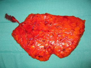 Breast Reconstruction with the DIEP flap. Intraoperative picture of the raised flap. The flap has been rotated 180 degrees in order to demonstrate the positioning of the flap at the recipient site. Note the vascular pedicle and the perforators