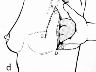 Schema: ricostruzione mammaria mediante lembo toracico laterale. Posizionanemto della protesi mammaria