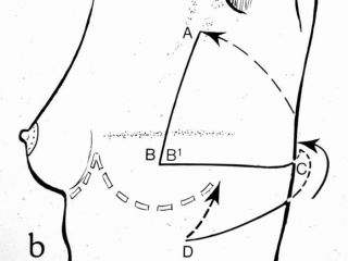Schema: ricostruzione mammaria mediante lembo toracico laterale. Riferimenti antropometrici per il disegno del lembo