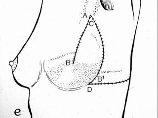 Schema: ricostruzione mammaria mediante lembo toracico laterale. Aspetto postoperatorio